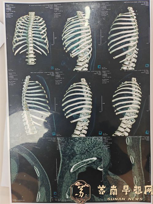 农民工蓝田隧道施工意外肋骨骨折， 施工方陕西高驰建筑公司&ldquo;漠不关心&rdquo;