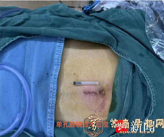 句容市人民医院普外科微创技术再突破，单孔腹腔镜疝修补术成功开展