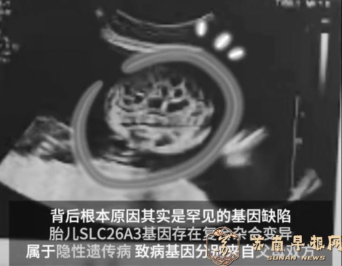产检发现：胎儿在妈妈腹中&ldquo;拉肚子&rdquo;